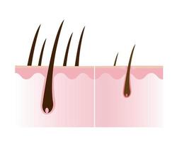 comparação do saudável e perdendo cabelo com couro cabeludo camada vetor isolado em branco fundo. cabelo densidade, perda, alopecia, calvície e Calvo. cabelo anatomia conceito ilustração.