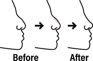 rinoplastia antes e depois de a procedimento infográficos. nariz plástico cirurgia vetor esboço conceito médico ilustração