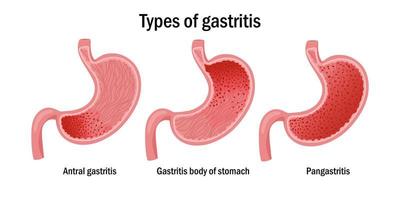 três tipos do gastrite ilustração vetor