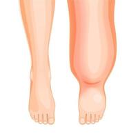 edema pé doença, inchado perna sintoma ou problema vetor