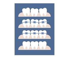 dental suspensórios ícone. ortodôntico tratamento e Cosmético odontologia. antes depois de endireitar dentes. vetor plano ilustração