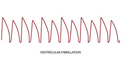 ecg batimento cardiaco linha. eletrocardiograma vetor ilustração. ventricular fibrilação