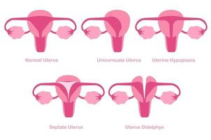 anomalias mullerianas congênitas ou ilustração do conceito de anomalias uterinas. condição reprodutiva feminina. vetor