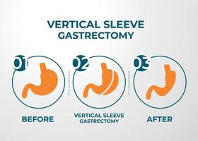 gastrectomia de manga laparoscópica, gastrectomia vertical, ilustração vetorial de cirurgia de perda de peso de cirurgia de redução de estômago vetor