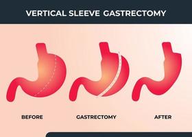 gastrectomia de manga laparoscópica, gastrectomia vertical, ilustração vetorial de cirurgia de perda de peso de cirurgia de redução de estômago vetor