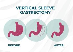 gastrectomia de manga laparoscópica, gastrectomia vertical, ilustração vetorial de cirurgia de perda de peso de cirurgia de redução de estômago vetor