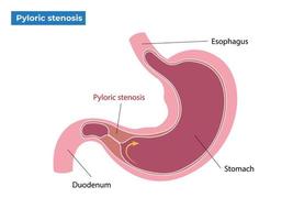 sintomas do pilórico estenose vetor ilustração