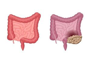 anatomia do intestino humano forte e saudável com comparação ao câncer de cólon. tumor oncológico digestivo e excretor de órgãos internos da cavidade abdominal. ilustração de eps de problema de digestão vetorial vetor