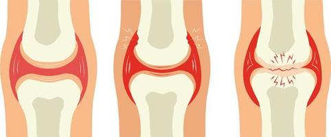 joelho articulação dor. vetor ilustração isolado em uma branco fundo.