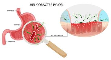 helicóptero pylori infecção dentro estômago úlcera debaixo ampliação. vetor