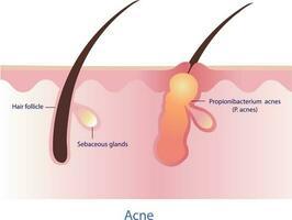 causa do acne com pele superfície vetor em branco fundo. pele Cuidado e beleza conceito ilustração.