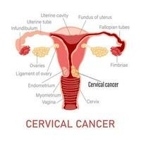 cervical Câncer. doenças do a fêmea reprodutivo sistema. ginecologia. médico conceito. infográfico bandeira. vetor