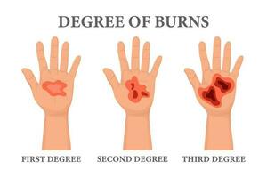 queimar estágios. queimado mãos às vários graus. pele queimar sintomas. médico cuidados de saúde conceito. vetor