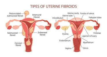 tipos do uterino miomas dentro mulheres. miomas. doenças do a fêmea reprodutivo sistema. saudável e pouco saudável útero. ginecologia. médico conceito. infográfico bandeira. vetor