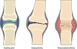 ilustração do saudável articulação vs artrite comparação vetor