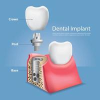 ilustração em vetor dentes humanos e implante dentário