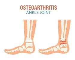 reumatóide artrite. osteoartrite do a humano tornozelo articulações. médico conceito. infográfico poster, bandeira, vetor