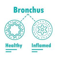 infográfico de bronquite vetor