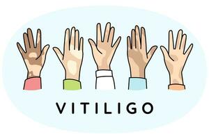 diversas mãos de pessoas sofrem de doença de vitiligo. as pessoas lutam com a pigmentação no corpo. conceito de dia mundial do vitiligo. ilustração vetorial. vetor