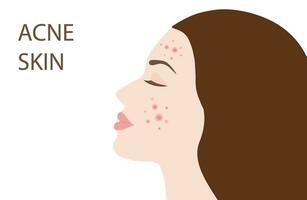 rosto de mulher jovem com acne na pele, espinhas, ilustração vetorial de cravos. conceito de problema de rosto de pele de acne vetor