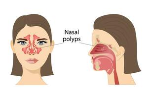 médico vetor ilustração do nasal pólipos. Não canceroso neoplasias em a nasal mucosa ou seios da face em uma branco fundo