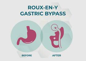 gástrico desviar rny peso perda cirurgia vetor ilustração ícone roux-en-y