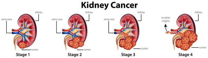 Diagrama mostrando diferentes estágios do câncer renal vetor