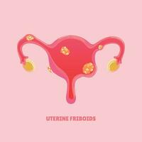 uterino miomas doença vetor ilustração