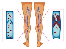 Diagrama mostrando o coágulo de sangue nas pernas humanas vetor