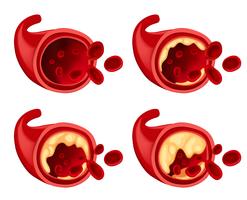 Diagrama mostrando gordura no sangue vetor