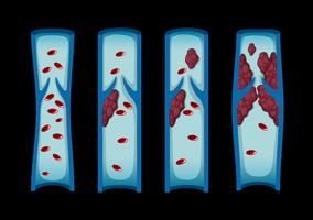 Diferentes fases do coágulo sanguíneo em humanos vetor