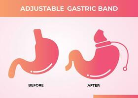 ilustração de vetor de cirurgia para perda de peso com dispositivo de banda gástrica ajustável