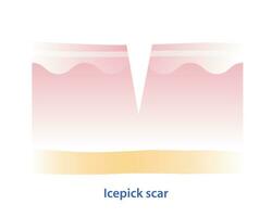 Cruz seção do picador de gelo cicatriz vetor ilustração isolado em branco fundo. picador de gelo cicatriz, atrófico cicatriz, tipo do acne cicatriz em pele superfície. pele Cuidado e beleza conceito.