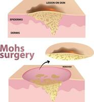 ilustração do mohs cirurgia vetor