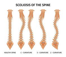 coluna vertebral escoliose anatomia infográficos vetor