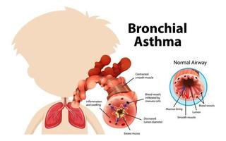 diagrama de asma brônquica com via aérea normal e via aérea asmática vetor