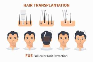 etapas de extração de unidade de fue de transplante de cabelo vetor