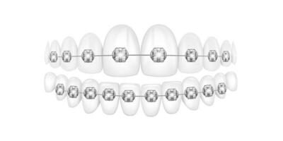 Ilustração em vetor 3D, dentes realistas com aparelho. alinhamento da mordida dos dentes, dentição com aparelho, aparelho dentário.