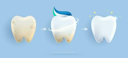 conjunto do dental limpeza e branqueamento dentes conceito. comparação do limpar \ limpo e sujo dente. dental saúde e oral higiene poster para odontologia. exame dentes, branqueamento e reparar. vetor Projeto.