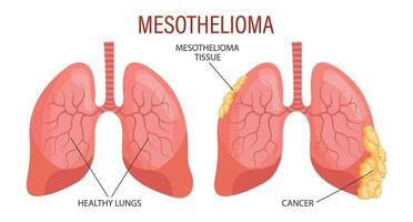 estágios do mesotelioma, pulmão doença. assistência médica. médico infográfico bandeira, ilustração, vetor