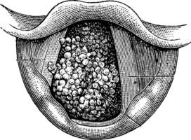papiloma do a laringe, vintage gravação vetor