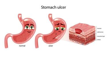 estômago úlceras. fofa feliz e triste estômago personagens com rostos. estômago Cruz seção diagrama. anatômico vetor ilustração