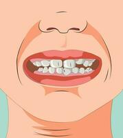 humano boca ilustração mostrando dentes e nariz vetor