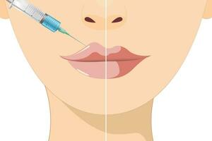lábio aumento e correção. lábio enchimento injeções. hialurônico ácido. cosmetologia procedimento dentro uma beleza salão vetor