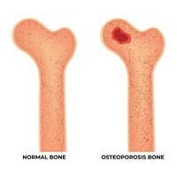 normal osso e osteoporose osso Ciência Projeto vetor ilustração