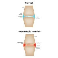 normal e reumatóide artrite Ciência Projeto vetor ilustração