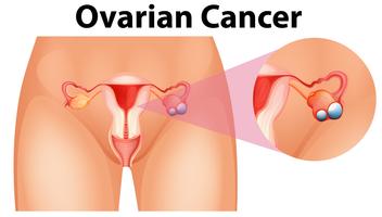 Diagrama mostrando câncer de ovário vetor