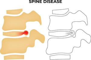 coluna vertebral doença Ciência Projeto vetor ilustração diagrama