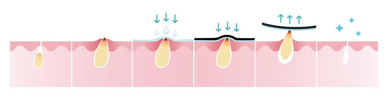 Cruz seção do cravo acne e quão para retirar espinha vetor isolado em branco fundo. molhado a pele, aplicar, descasca desligado, desobstruindo e apertar poro. pele Cuidado e beleza conceito ilustração.