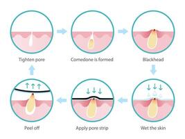 vida ciclo do cravo remoção vetor isolado em branco fundo. Cruz seção do diagrama cravo poro pele, comedão é formado, expandir para não inflamatório acne, tratamento com poro faixa.